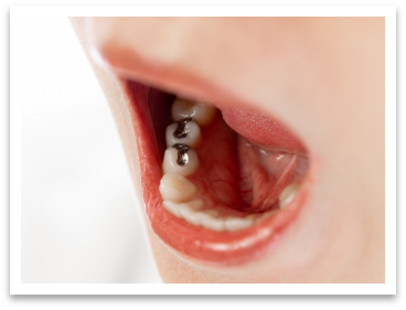 虫歯のつめもの