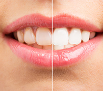 ホワイトニング